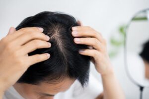薄毛に合った髪型は？原因を知って自信を取り戻そう！